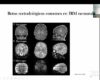 El uso de imagen por resonancia magnética es importante para el estudio del cerebro de lactantes prematuros