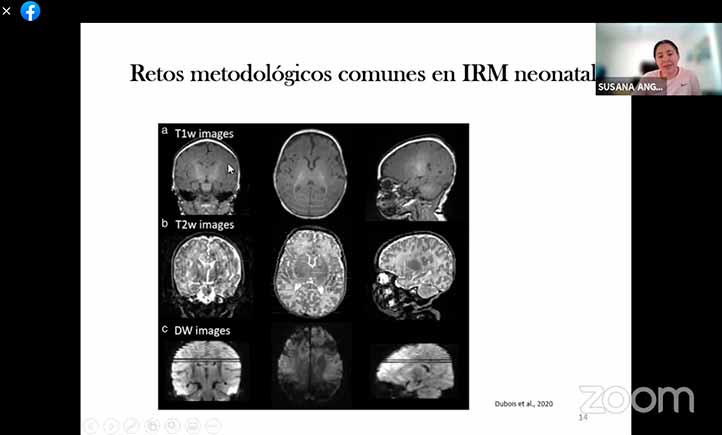 El uso de imagen por resonancia magnética es importante para el estudio del cerebro de lactantes prematuros 