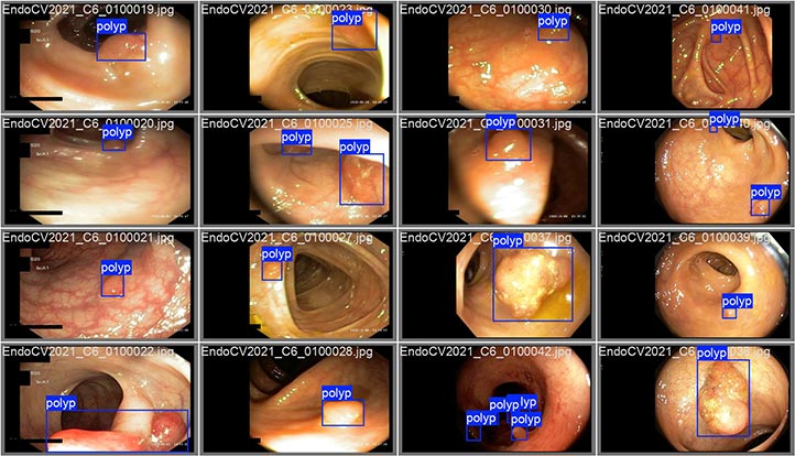 La IA apoya la detección de pólipos realizada mediante una colposcopía